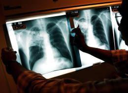 A case of Tuberculosis has been confirmed at a Scarborough school. (Getty)