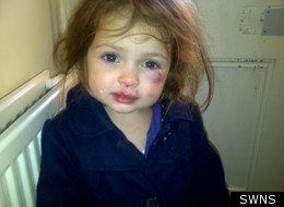 Katie Ann Guttridge sustained a bruised eye socket, scratches and bite marks in the attack