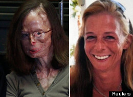 Patricia Lefranc is still in constant agony after the acid attack in 2009