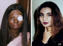 Fakhra younas was asleep when acid was thrown on her face and body