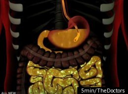 A man in Canada who suffered from a bacterial infection known as Clostridium difficile, or C. difficile, since undergoing routine surgery 18 months ago, took drastic measures to save his life with a self-injected fecal transplant. It's becoming more common and is done by enema or through a tube in the nose.