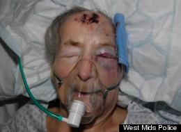 Emma Winnall suffered severe injuries