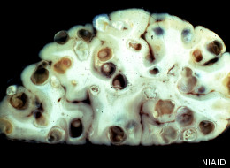 A human brain overrun with cysts from Taenia solium, a tapeworm that normally inhabits the muscles of pigs