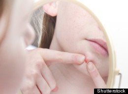 Skin habits that you should stop doing right away include not squeezing your blemishes, no matter how tempting they are.