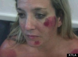 A photo of the injuries Michelle Jordan claims to have suffered at the hands of LAPD officers.