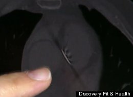 Dale Carman was mowing his lawn when this four-inch nail poked his heart.