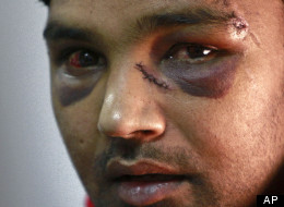 Pakistani bakery worker Ali Kaser, 25, claiming he was attacked by members of the extreme-right Golden Dawn party a day before the elections, is seen at United Against Racism and Fascist Violence Movement office during a press conference in Athens, Thursday, June 21, 2012. (AP Photo/Petros Karadjias)