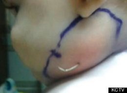 Doctors pulled a feather from a baby's neck